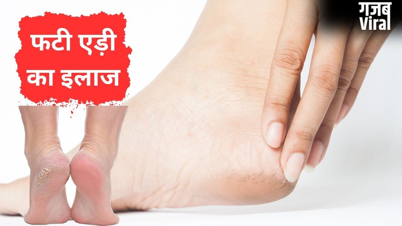 गर्मी में भी फट जाती हैं एड़ियां, इस तरह मुलायम बनाने और दरारें भरने में मिलेगी मदद, बरतें ये सावधानी