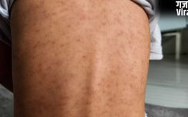 चेन्नई में खसरा के मामले बढ़े, जानें कारण, लक्षण और बचाव