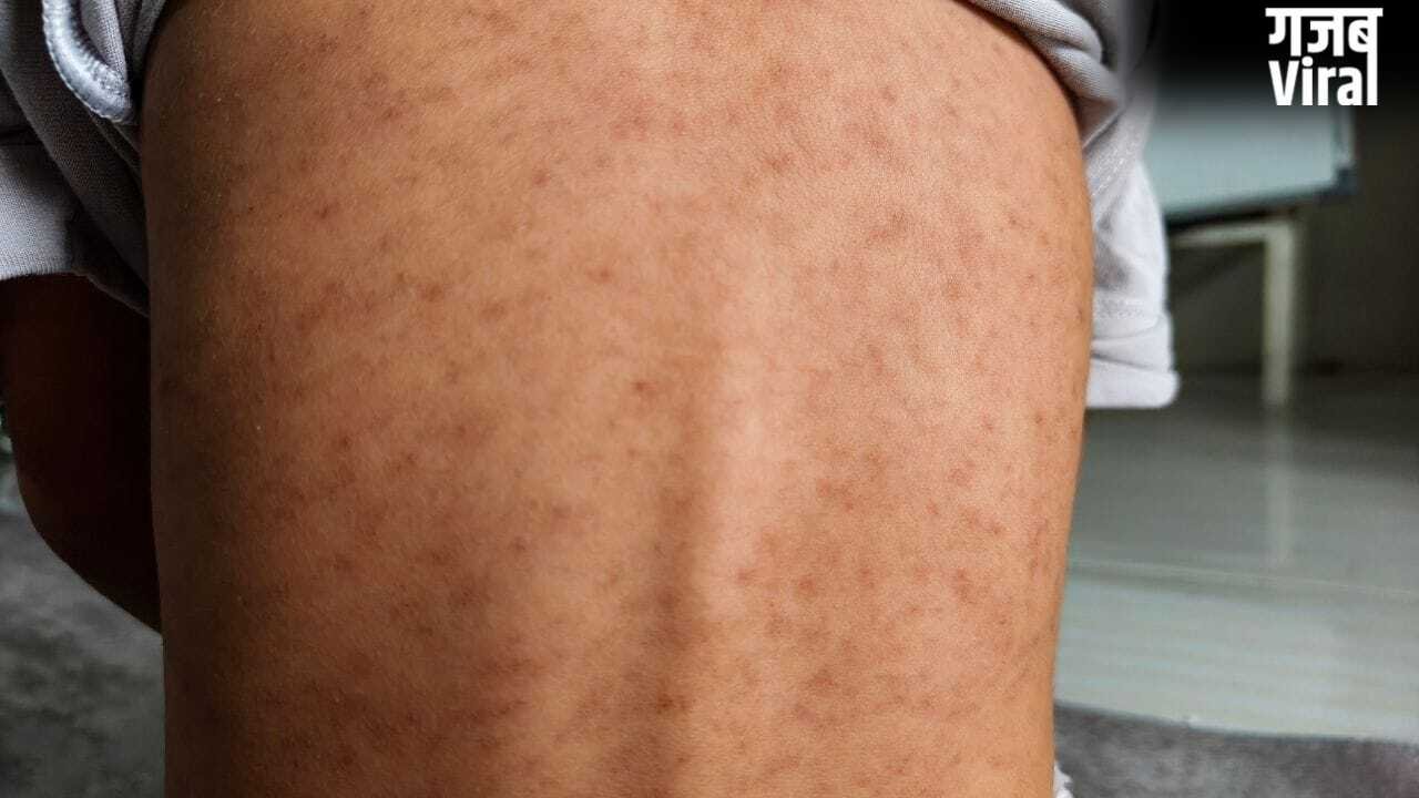 चेन्नई में खसरा के मामले बढ़े, जानें कारण, लक्षण और बचाव