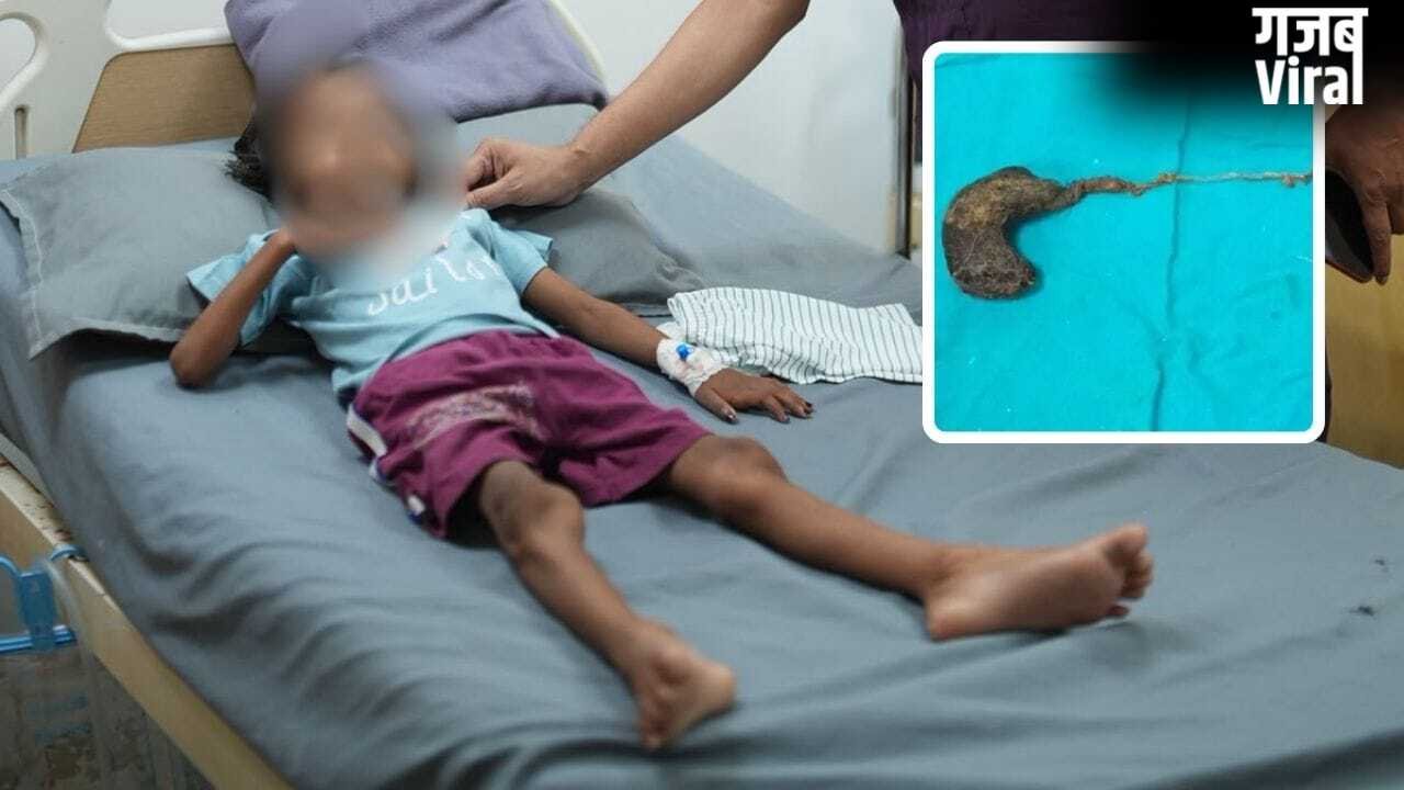 गोरखपुर में 7 साल की बच्ची के पेट से निकला बालों का गुच्छा, डॉक्टर भी रह गए हैरान; बाल खाने की आदत थी