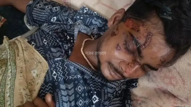 ​​​जेब में रखा Motorola फोन अचानक फटा, बुरी तरह झुलसा युवक, डॉक्टर ने टांकों की जगह लगा दिए स्टेपलर पिन​​​​