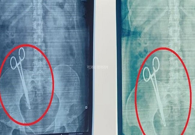 17 साल से पेट में दर्द से परेशान महिला का जब कराया गया एक्सरे, तो रिपोर्ट देख लोगो के उड़ गए होश​​​
