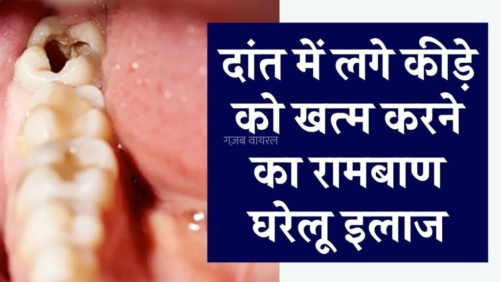 दांत का कीड़ा कैसे निकालें? कैविटी को खत्म करने के लिए रामबाण घरेलू उपाय​​​