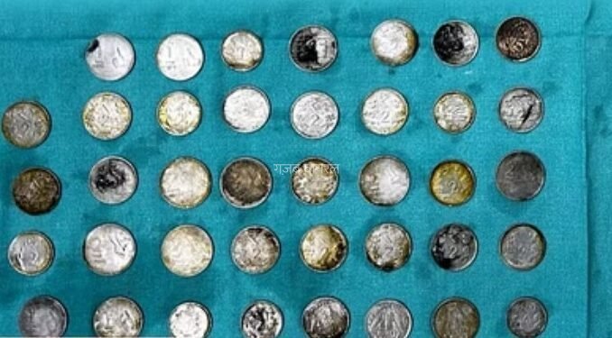 26 साल के युवक के पेट से निकले 39 सिक्के और 37 चुंबक के टुकड़े पेट में दर्द के बाद लाया गया था अस्पताल