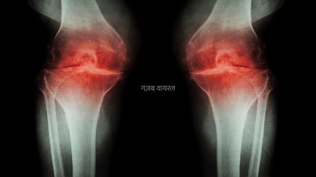 रोज झड़ेगा सारी 206 हड्डियों का कैल्शियम”, अगर ठीक नहीं हुई अंदर की 1 चीज, डॉक्टर की बात सुन छूटेंगे पसीने​​​