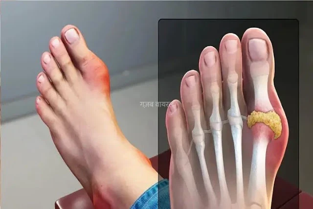 यूरिक एसिड हो जाएगा जड़ से साफ, रोज खाएं ये 5 रुपये वाला फल​​​