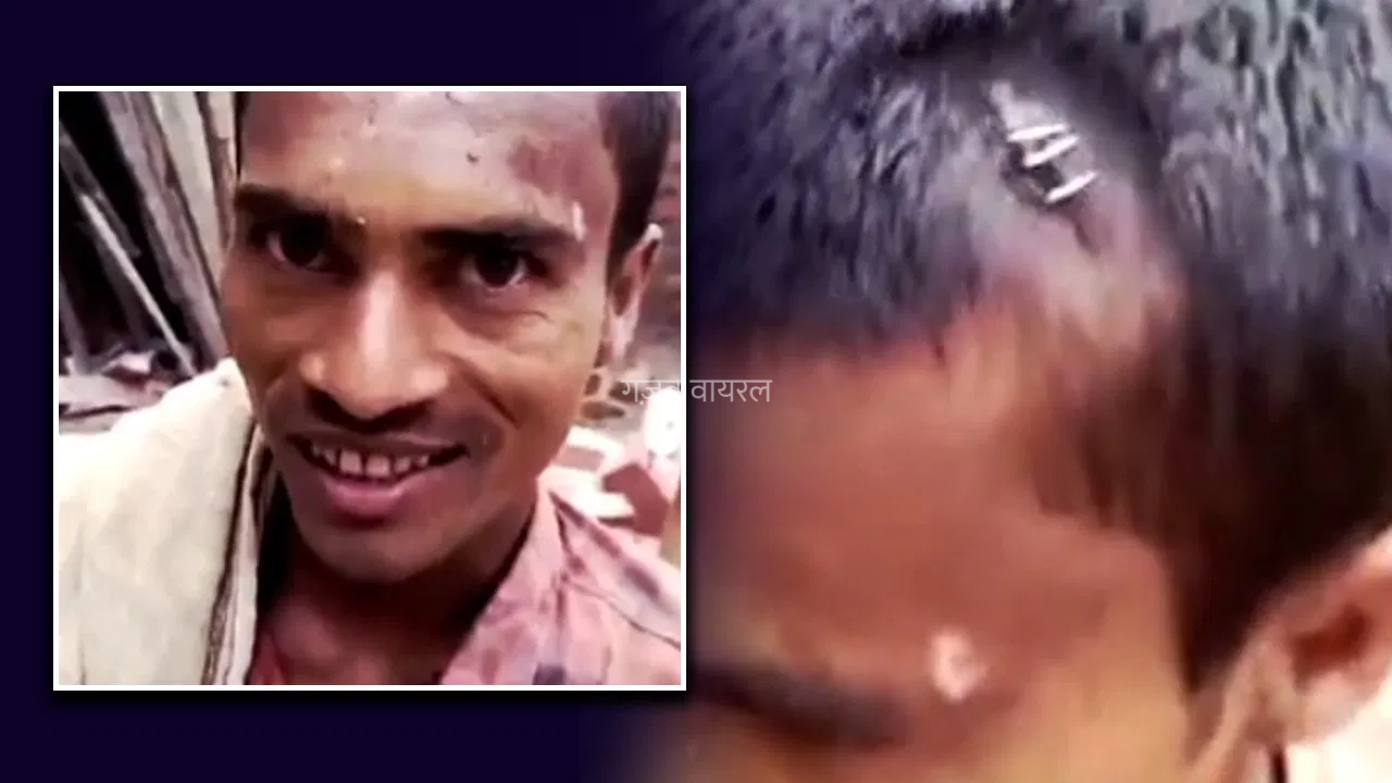 सिर फटा था… डॉक्टर ने स्टेपलर चला दिया! डॉक्टर या मजाक?…,नवादा में झोलाछाप डॉक्टर का अजीब इलाज वायरल​​​