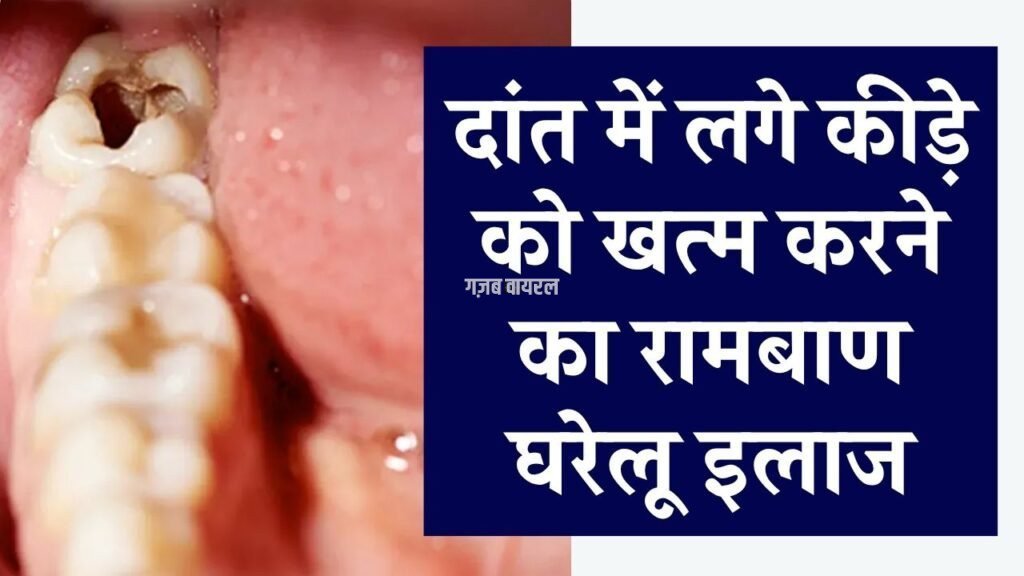 दांत का कीड़ा कैसे निकालें? कैविटी को खत्म करने के लिए रामबाण घरेलू उपाय